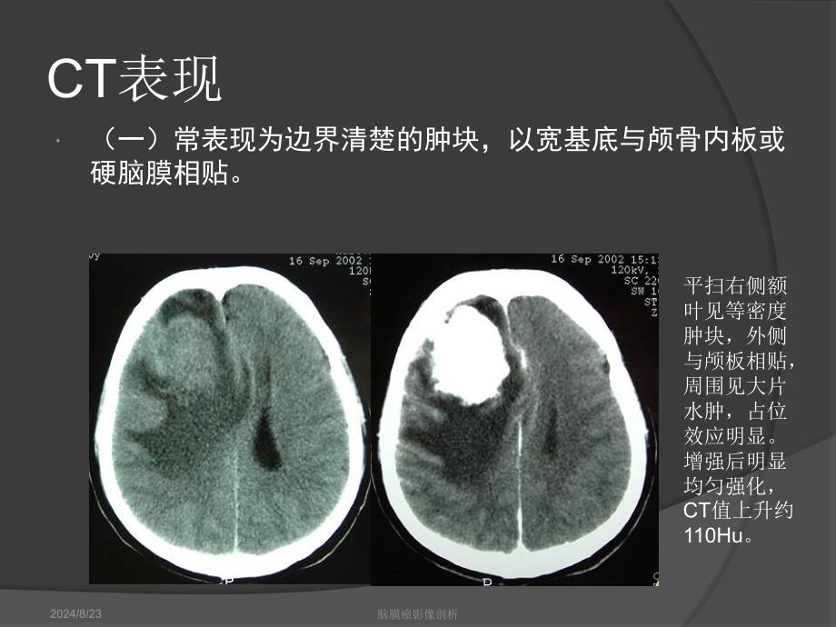 脑膜瘤影像学表现.ppt_第2页