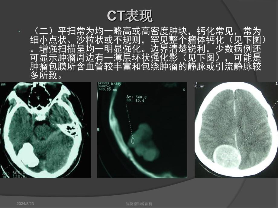 脑膜瘤影像学表现.ppt_第3页