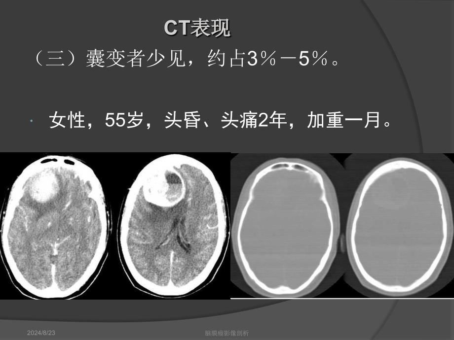 脑膜瘤影像学表现.ppt_第4页