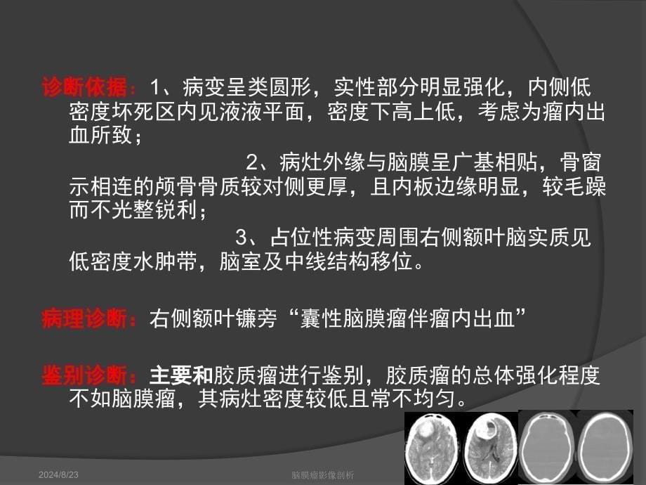 脑膜瘤影像学表现.ppt_第5页