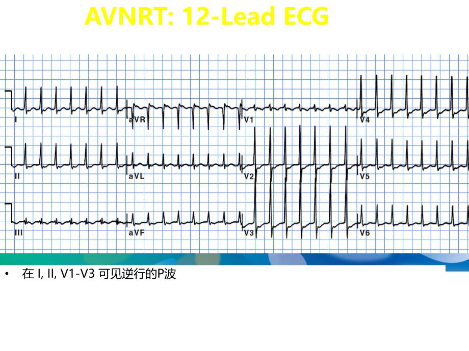 医学交流课件：双径路消融操作_第3页