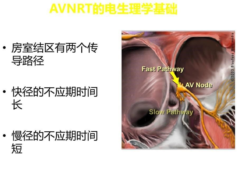 医学交流课件：双径路消融操作_第5页