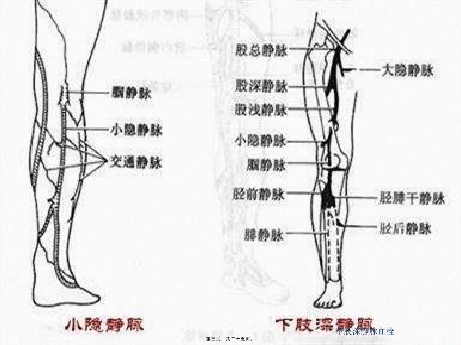 下肢深静脉血栓课件_第3页