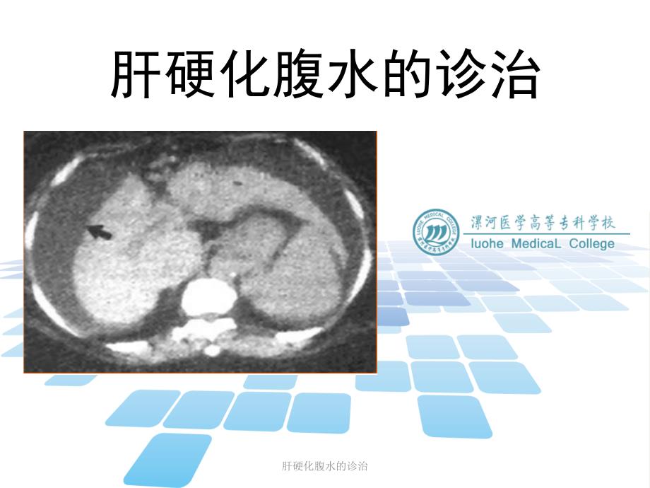 肝硬化腹水的诊治课件_第1页