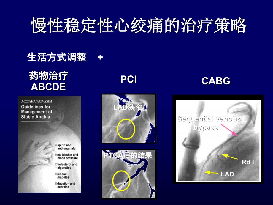 抗心绞痛药物治疗的新选择_第2页