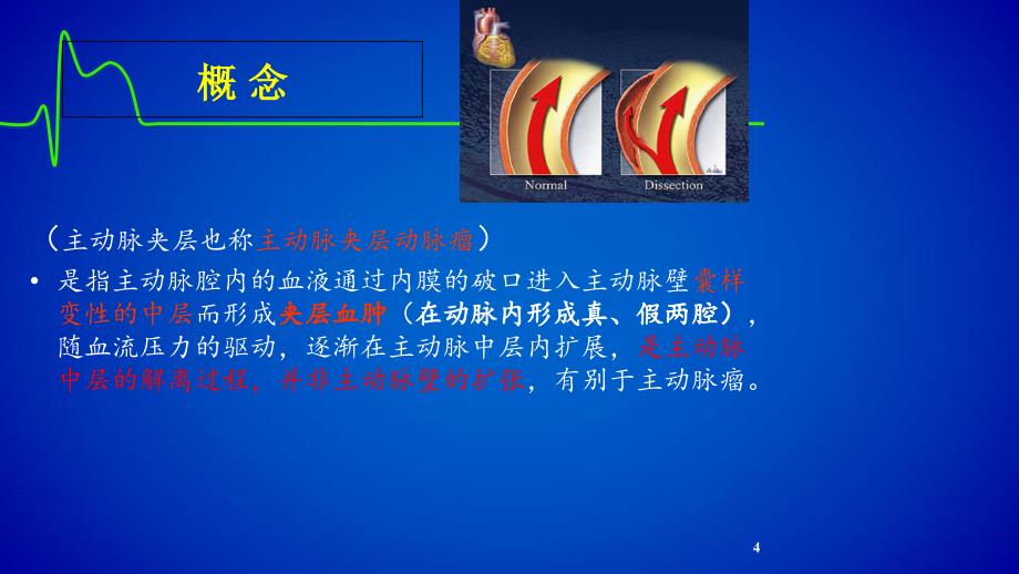 主动脉夹层(修改版)课件_第4页