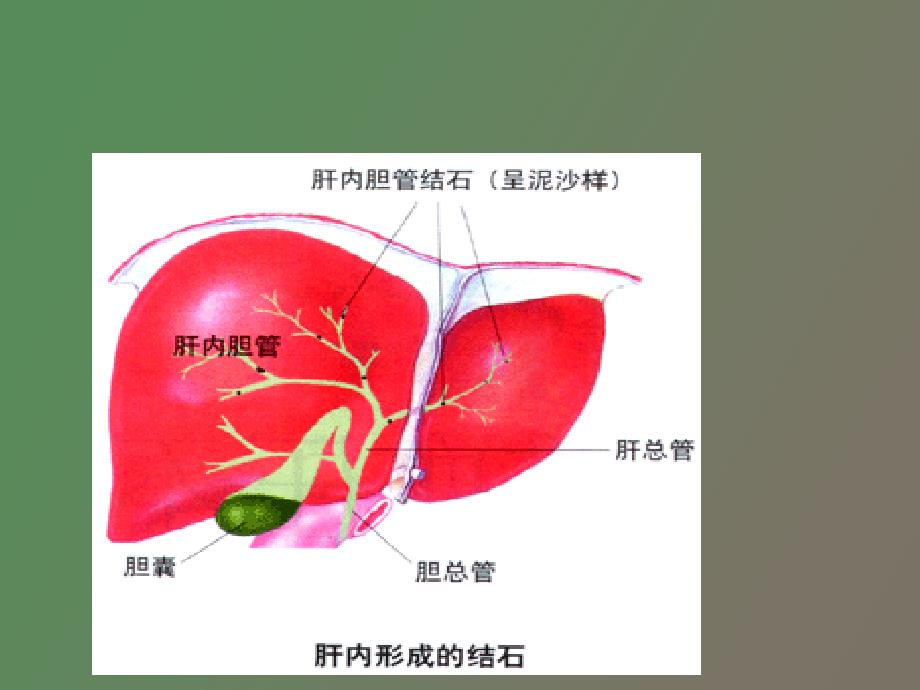 肝内外胆管结石病人的护理_第3页