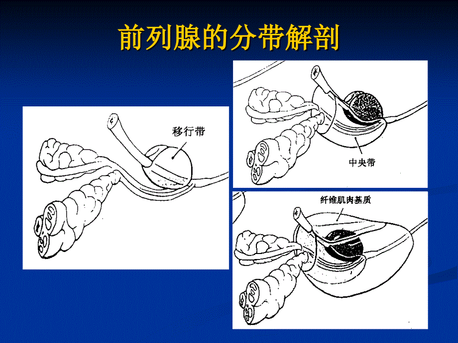 前列腺癌MRI诊断标准及分级.ppt_第4页