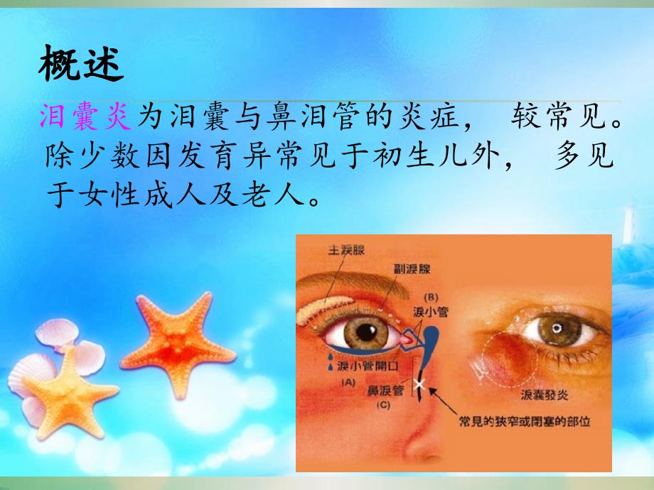 慢性泪囊炎患者的围手术期护理.ppt_第4页