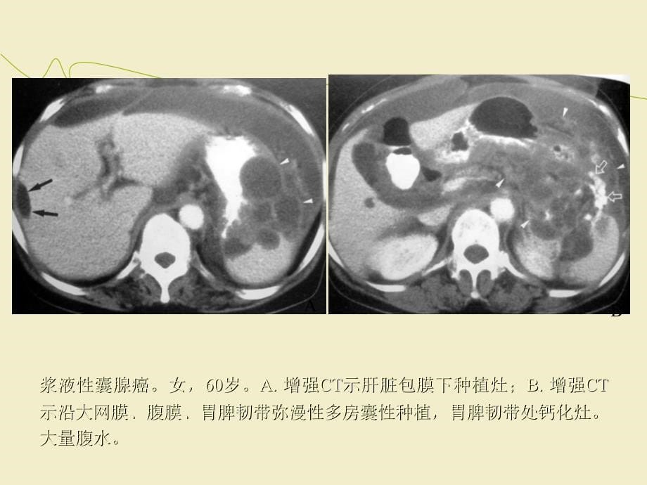 卵巢肿瘤的影像诊断及鉴别诊断ppt课件_第5页