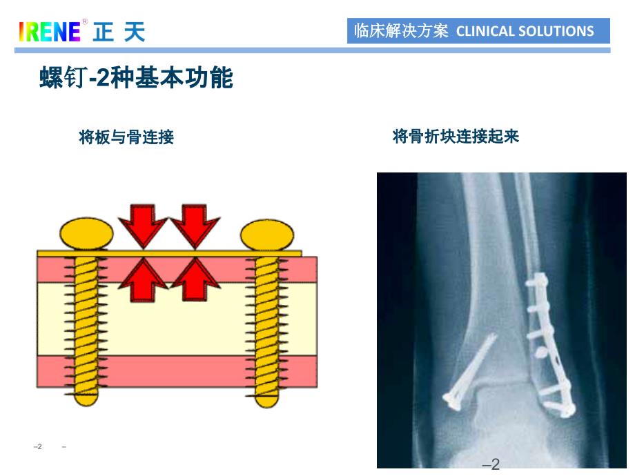 骨科基础螺钉设计与类型PPT参考幻灯片_第2页