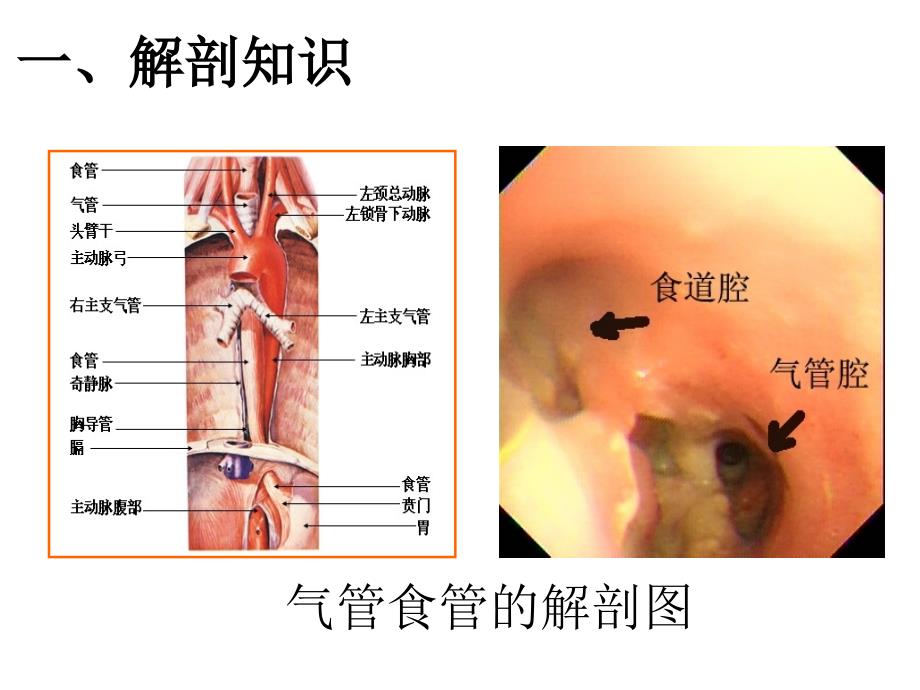 《气管食管瘘》PPT课件.ppt_第3页