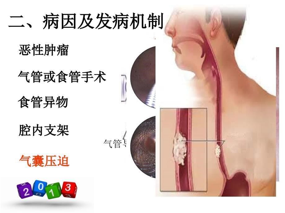 《气管食管瘘》PPT课件.ppt_第5页