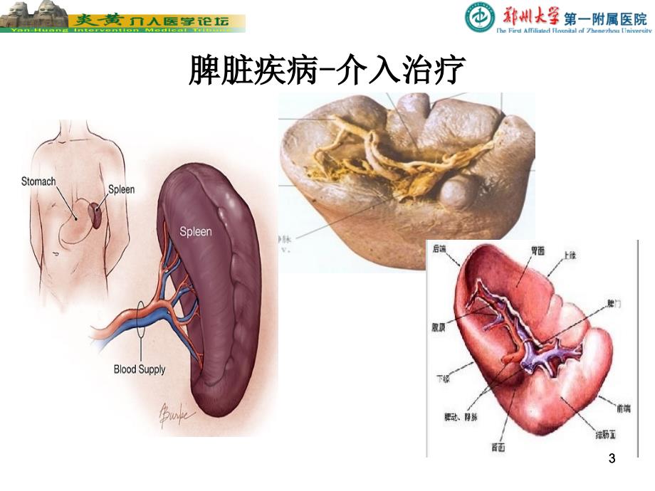 脾脏的介入栓塞治疗PPT参考幻灯片_第3页