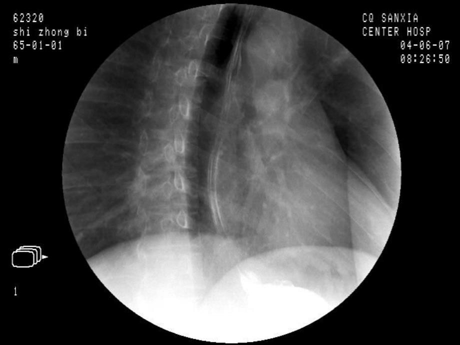 影像全套消化道钡餐图片_第3页