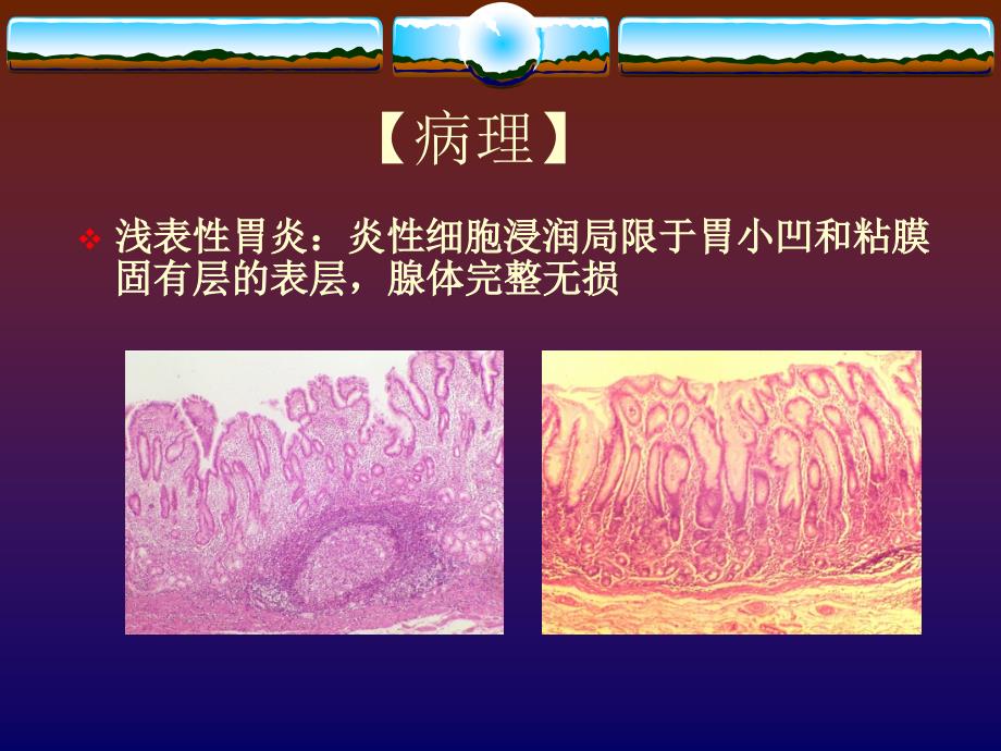 内科学：慢性胃炎_第3页