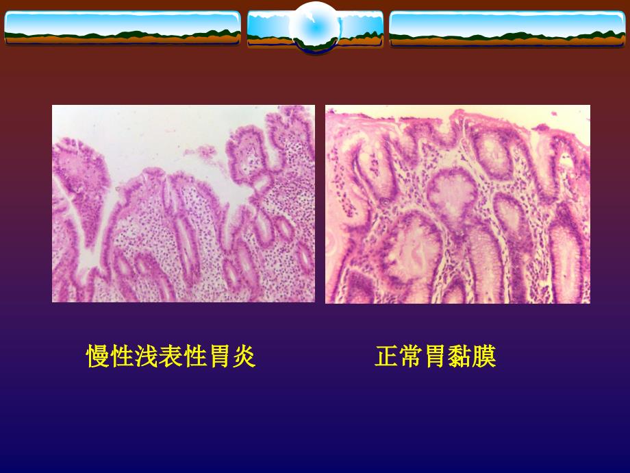 内科学：慢性胃炎_第4页