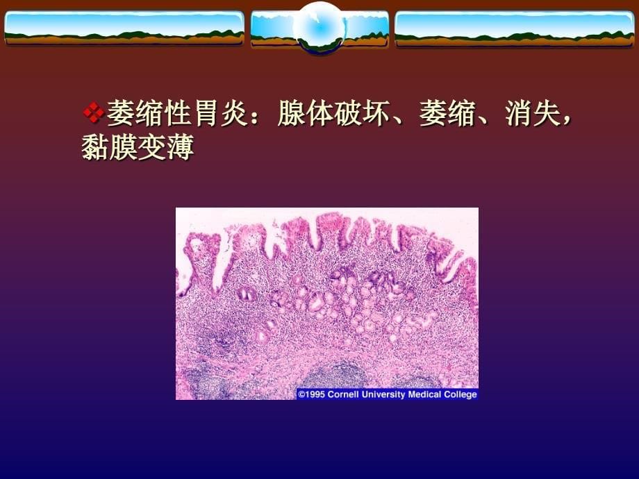 内科学：慢性胃炎_第5页