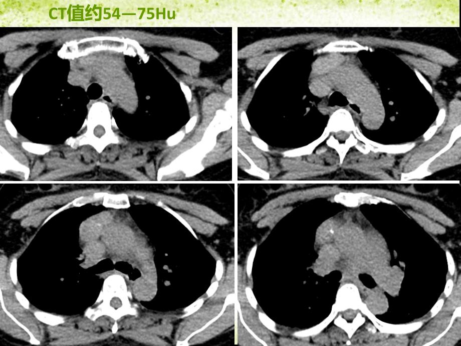 纵隔常见的肿瘤及瘤样病变ppt课件_第3页