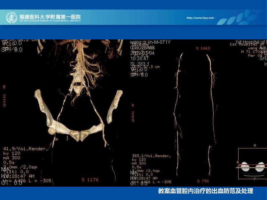 教案血管腔内治疗的出血防范及处理课件_第4页