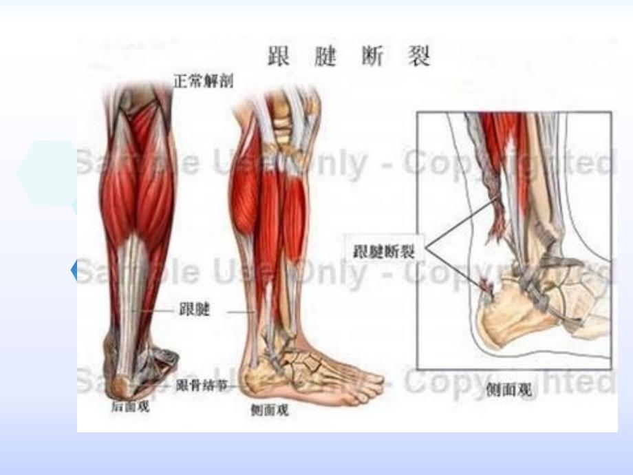 跟腱断裂护理查房_第3页