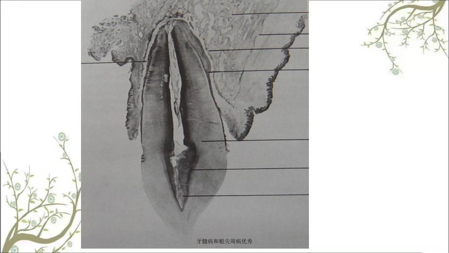 牙髓病和根尖周病优秀课件_第2页