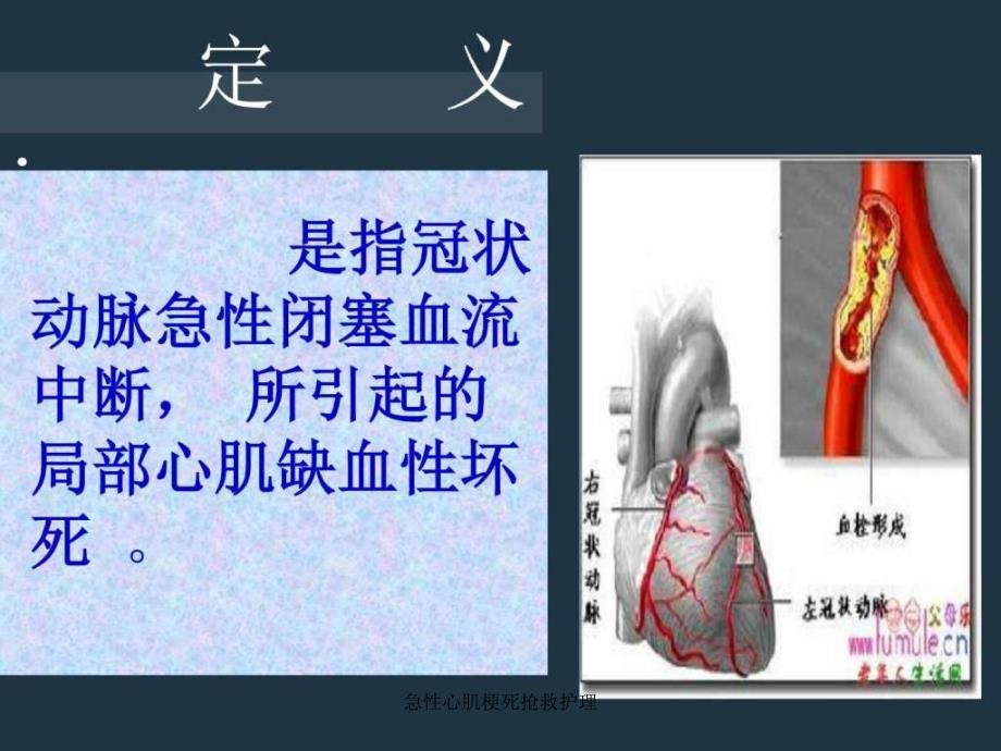 急性心肌梗死抢救护理课件_第3页