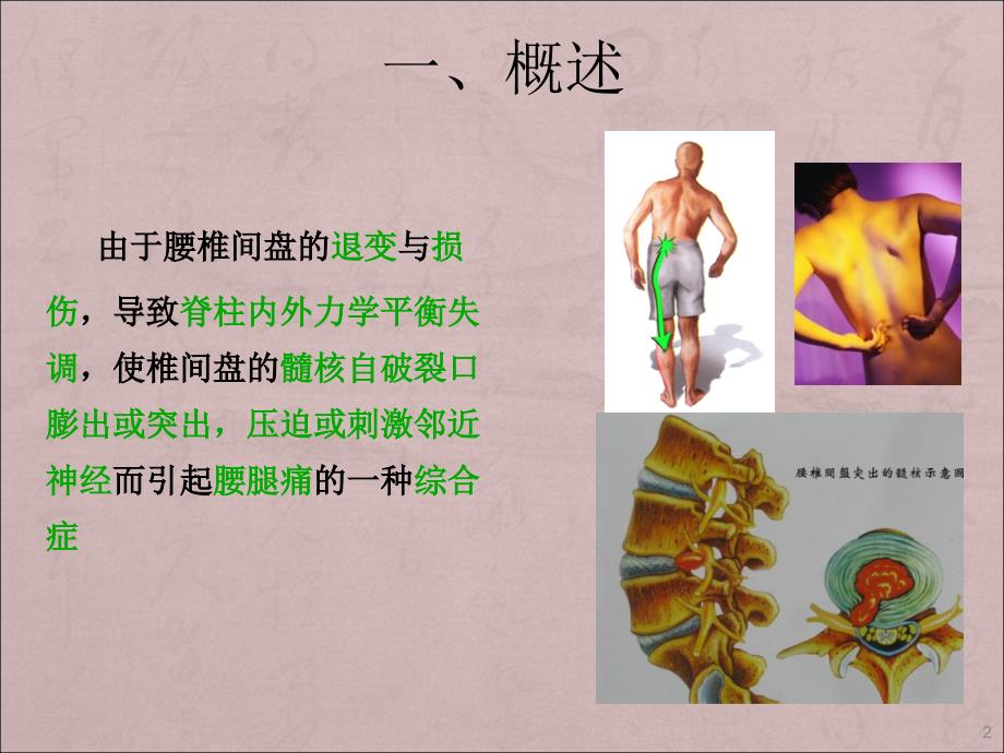 腰椎间盘突出症的注射治疗ppt课件_第2页