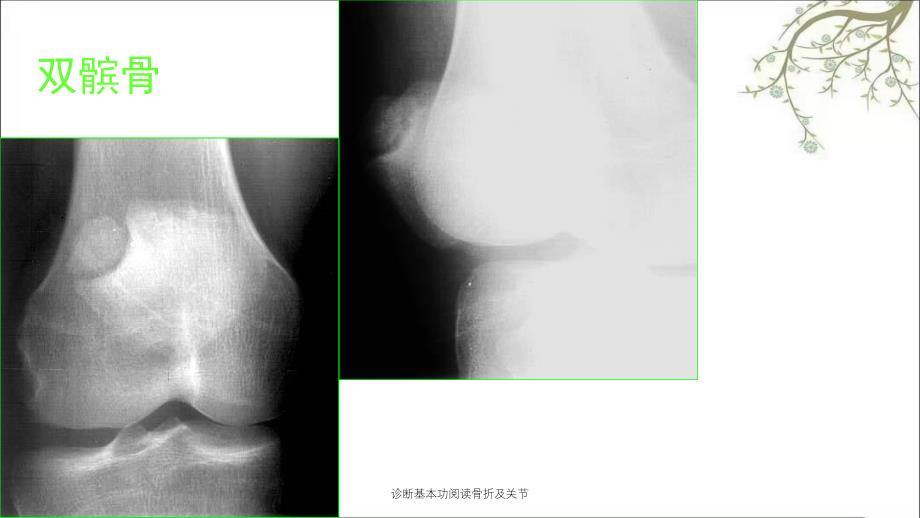 诊断基本功阅读骨折及关节_第4页