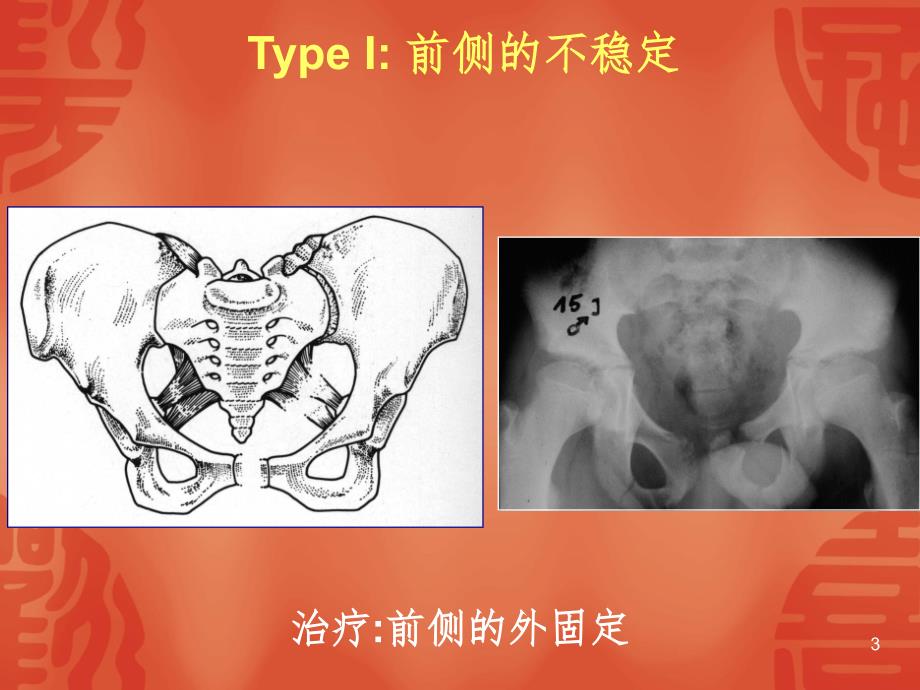 骨盆型外固定架PPT精品文档_第3页