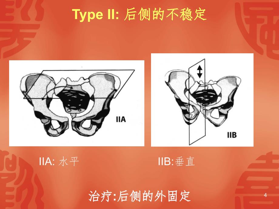 骨盆型外固定架PPT精品文档_第4页