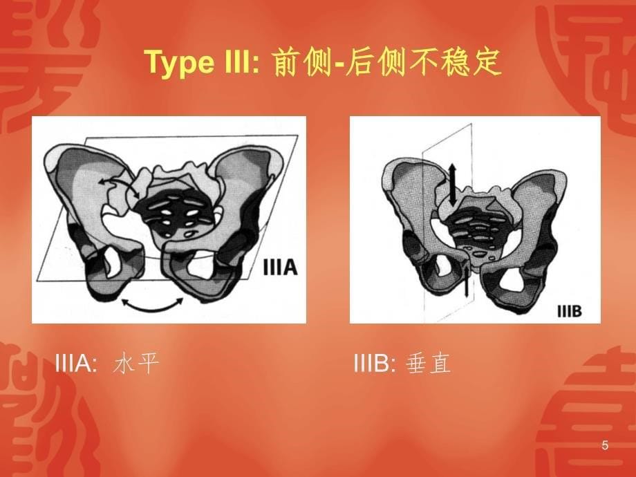 骨盆型外固定架PPT精品文档_第5页