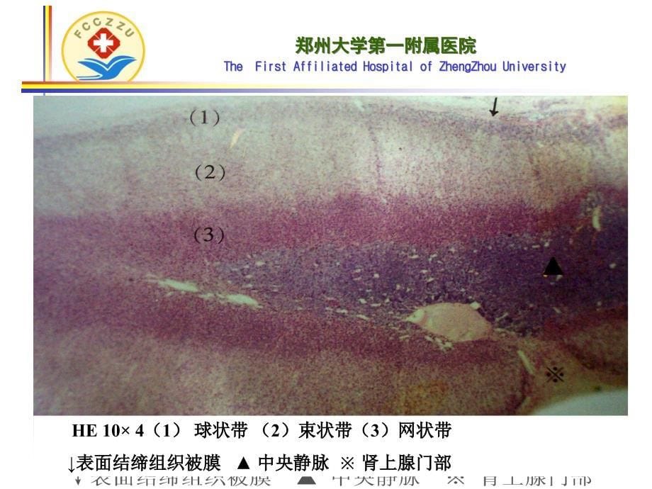 内科学教学课件：库欣综合征_第5页