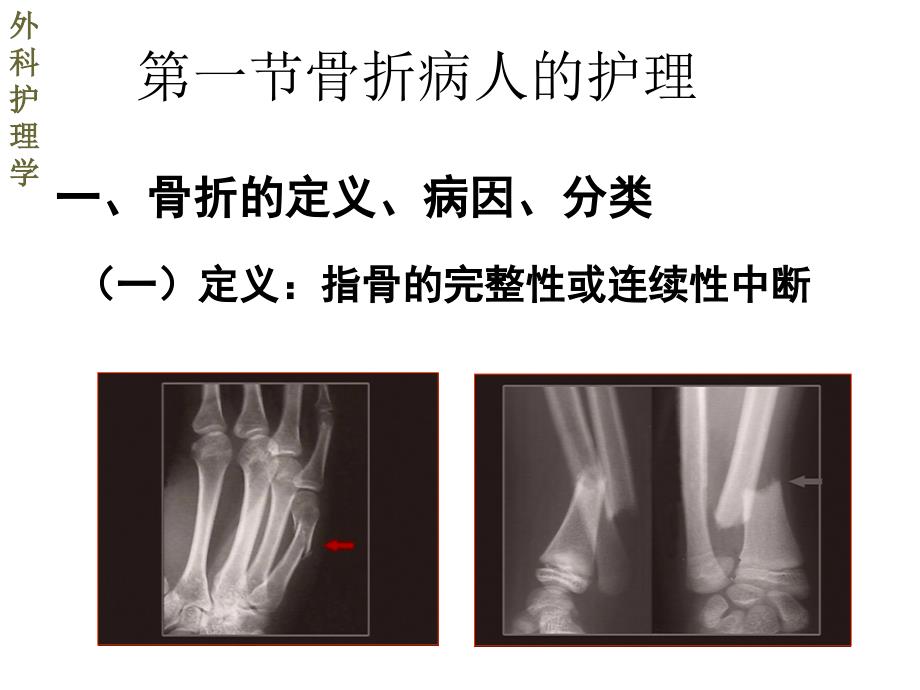 第一节骨折病人的护理课件_第3页