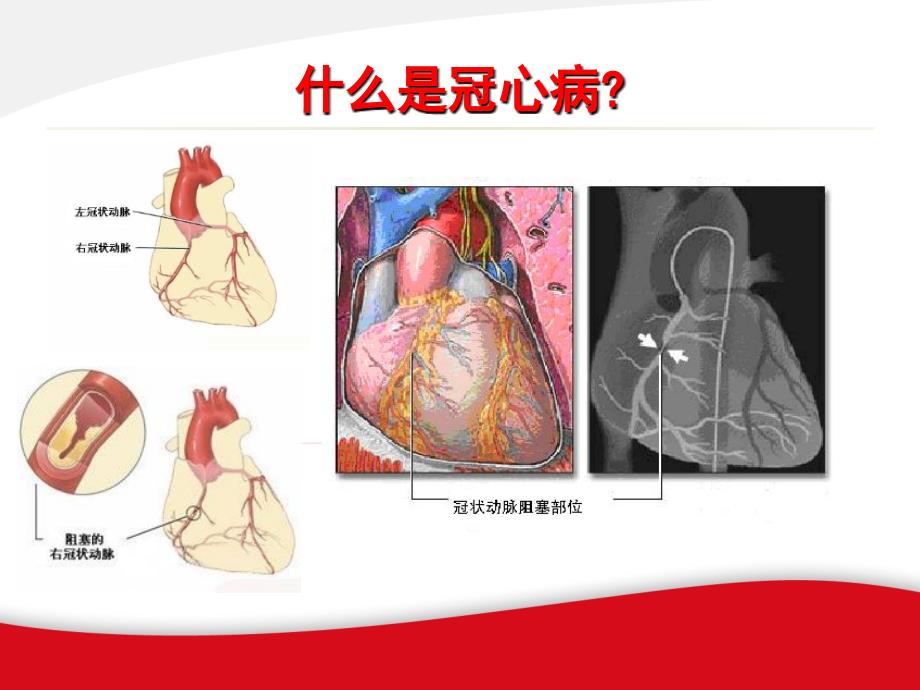 冬季冠心病防治患者教育_第2页