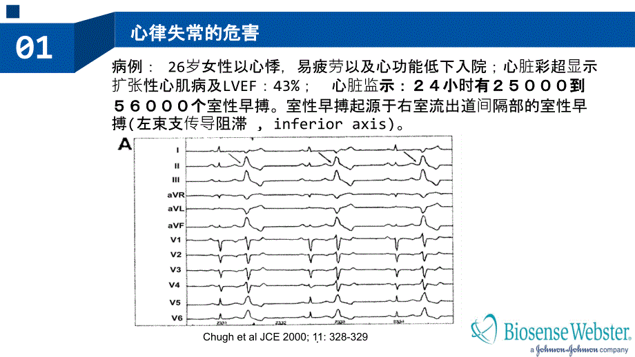 室性心律失常的射频消融治疗PPT课件_第3页