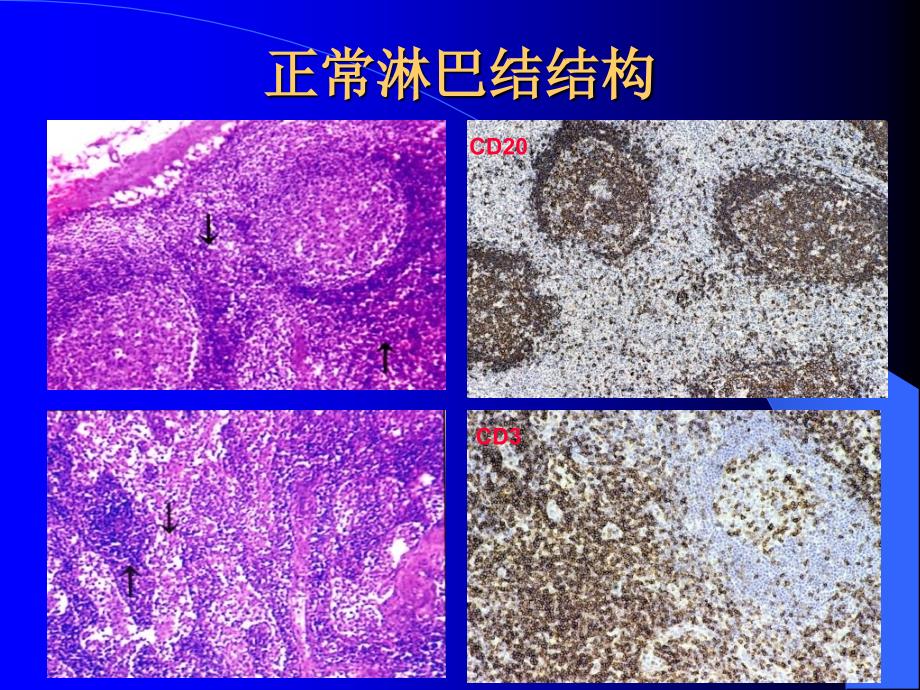 中山医科大学病理学课件第十章 淋巴造血系统疾病_第2页