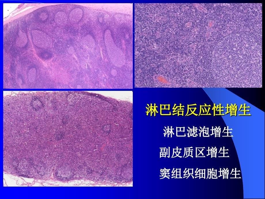 中山医科大学病理学课件第十章 淋巴造血系统疾病_第5页