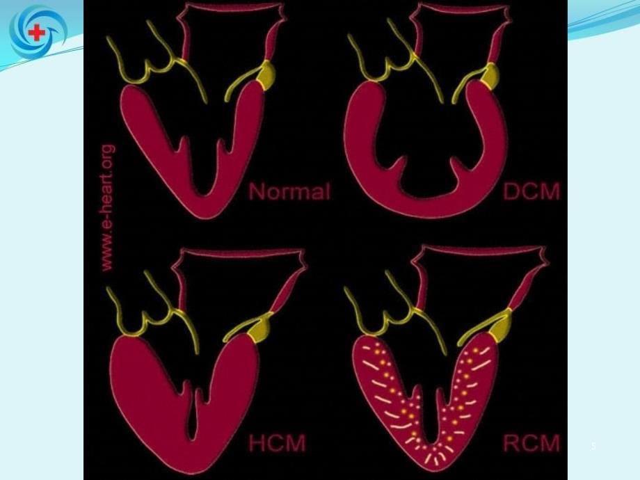 心肌疾病ppt课件_第5页