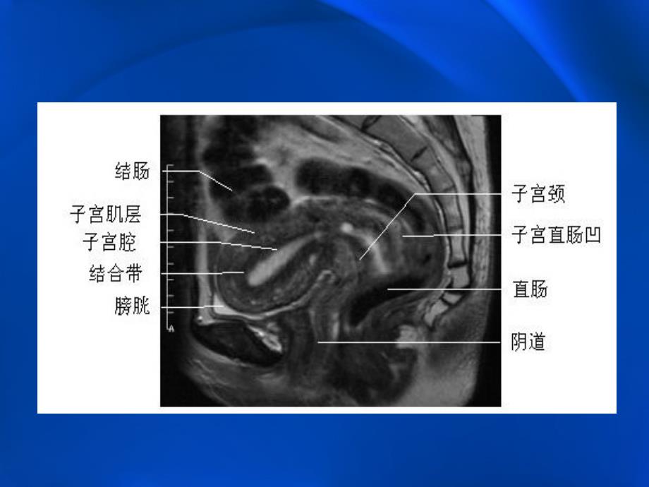 子宫内膜癌的MRI评价_第4页