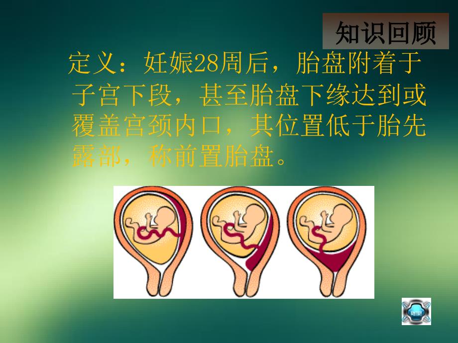 前置胎盘护理查房.ppt_第4页