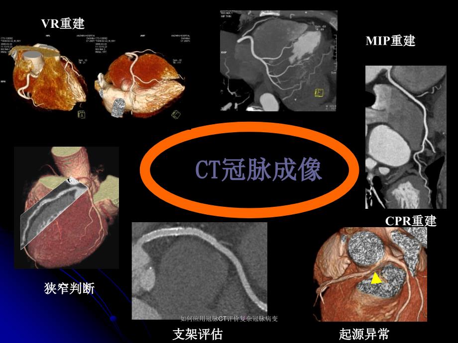 如何应用冠脉CT评价复杂冠脉病变课件_第3页