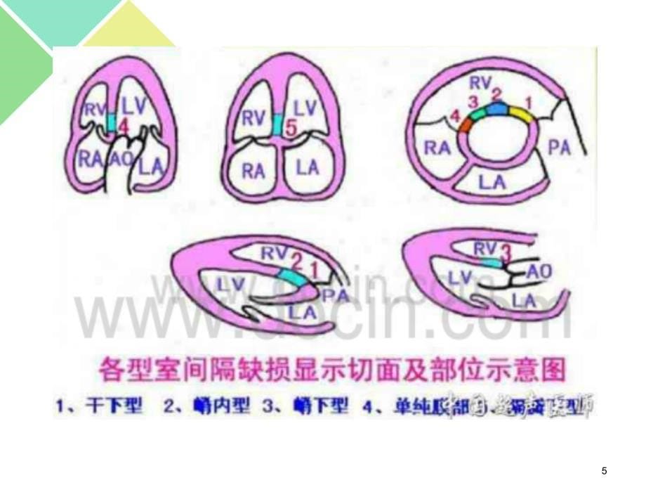 室间隔缺损分型及相关鉴别ppt课件_第5页