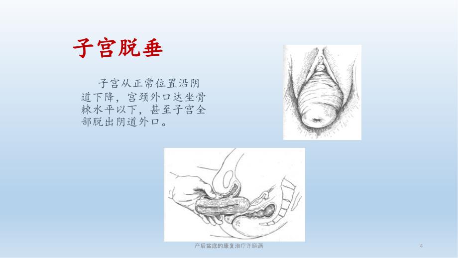 产后盆底的康复治疗许晓燕_第4页