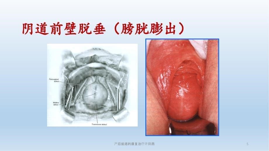 产后盆底的康复治疗许晓燕_第5页