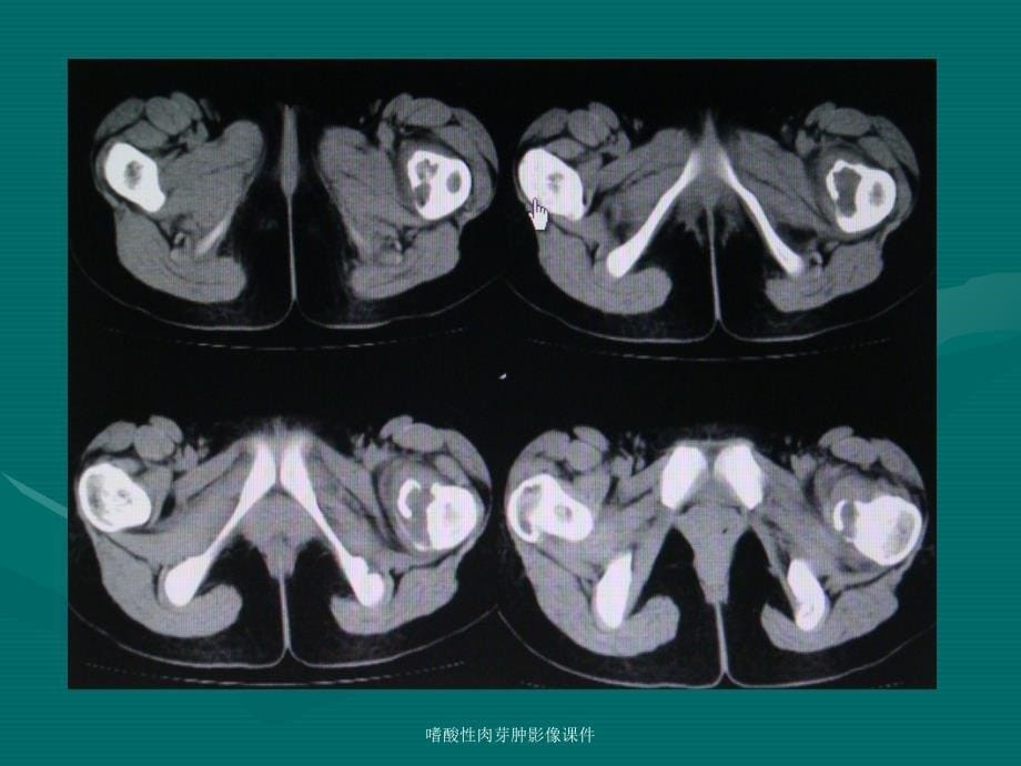 嗜酸性肉芽肿影像课件_第5页