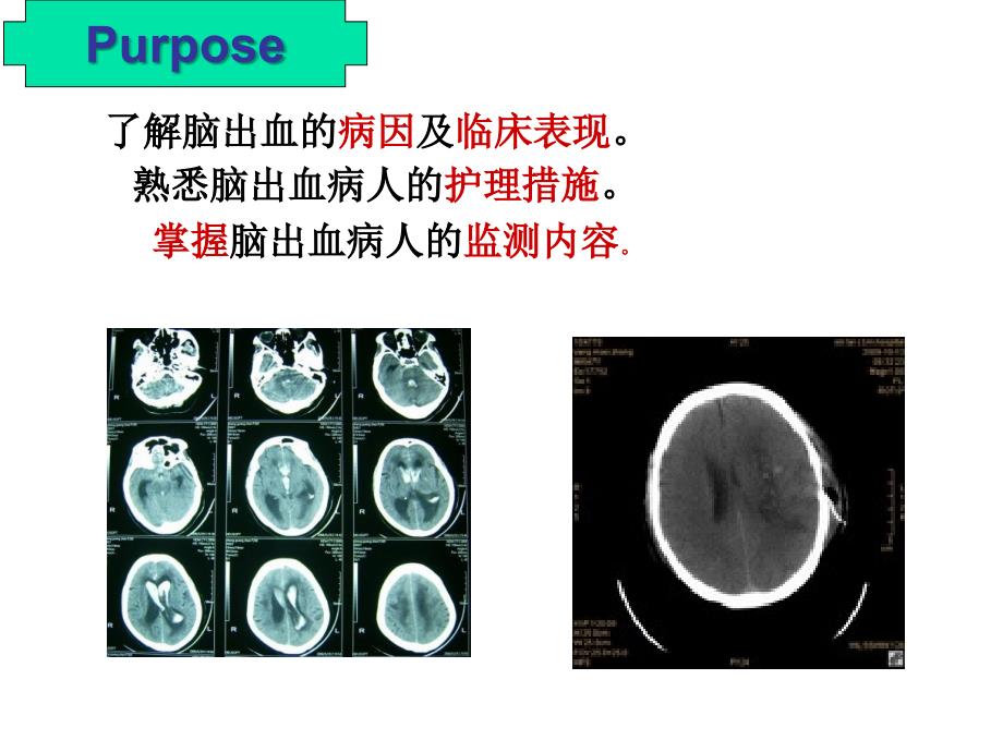 脑出血的护理ppt课件.ppt_第2页