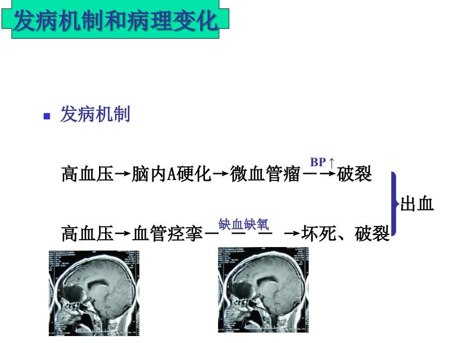 脑出血的护理ppt课件.ppt_第4页