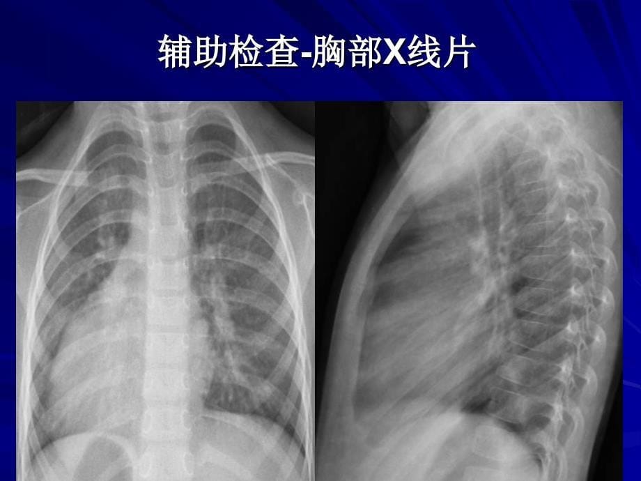 镜像右位心室间隔缺损封堵术一例_第5页