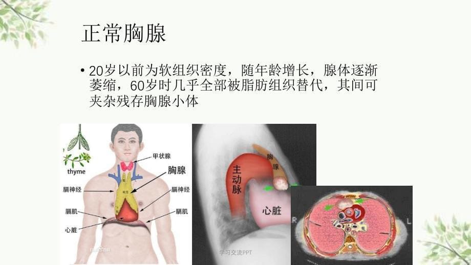 胸腺瘤的CT诊断课件_第5页